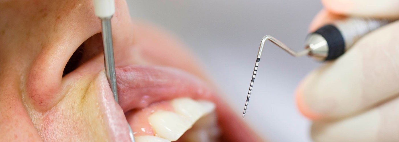 ¿Qué es una sonda periodontal y para qué se utiliza?